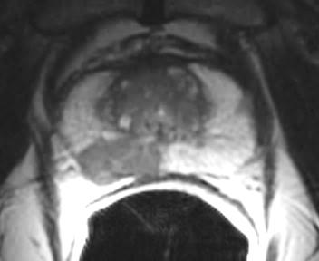 Prostate MRI: Potential Roles