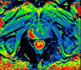 Prostate MRI: Detection/localization MRI can increase biopsy yield for high risk tumors after negative biopsy(ies) in patients with elevated PSA MR guided biopsy MR/US fusion guided