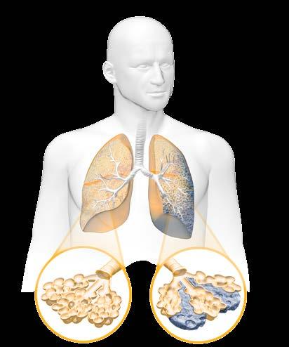 Everyone experiences lung function decline as they age, losing between 30-65 ml per year.