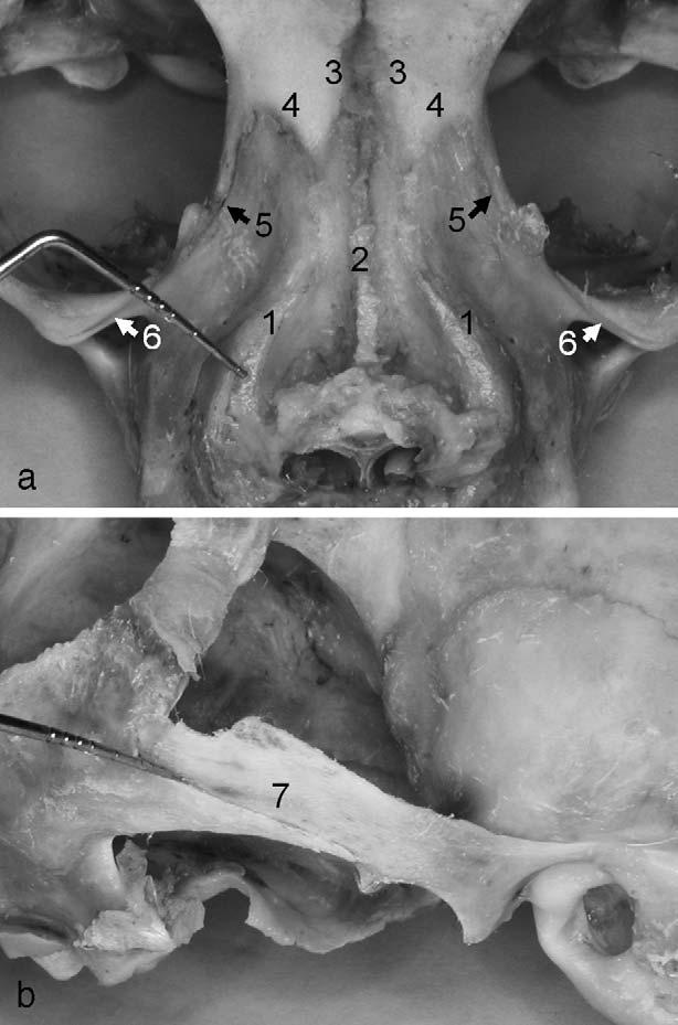 232 WANG, CHANG, LIOU maxilla (Sutures-1): the intermaxillary and nasomaxillary Sutures running coronally and articulating directly to maxilla (Sutures-2): the frontomaxillary suture at the