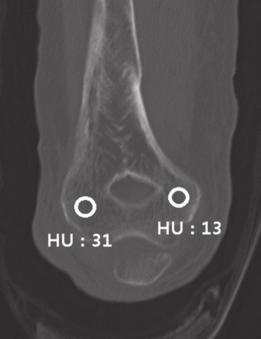 Seong Cheol Park, et al. showing that they have features of osteoporotic fracture. A few studies have mentioned that radial head and distal humerus fractures are potentially osteoporotic fractures.