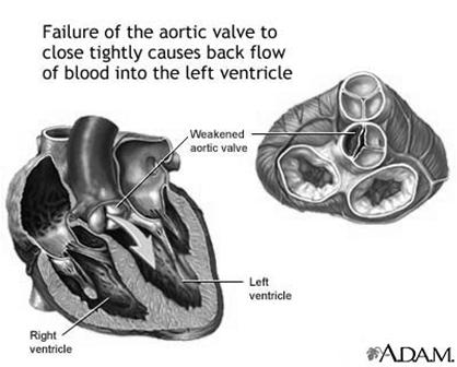 bicuspid aortic valve) Aortic dissection Aortic aneurysm