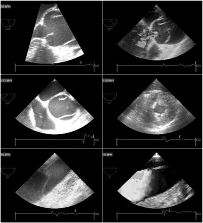 TEE Dissection flap Aortic regurgitation Flow in true and false