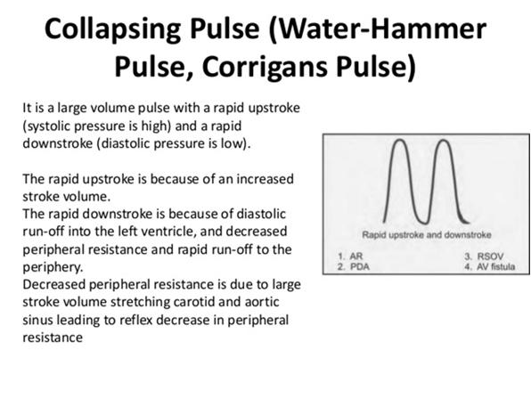 Physical exam Pulse Bounding pulse marked