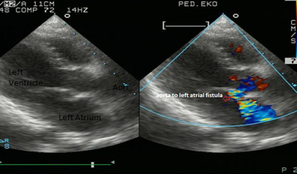 Cardiol Ther (2014) 3:67 71 69 Fig. 1 Pre-operative echocardiography Fig. 2 Aorta-to-left atrial fistula and gun pellet images with catheterization Fig.
