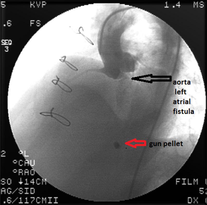 The patient is positioned so that the toe-side is on the left of the figure and head-side on the right Acquired aorta-to-left atrial fistula is usually