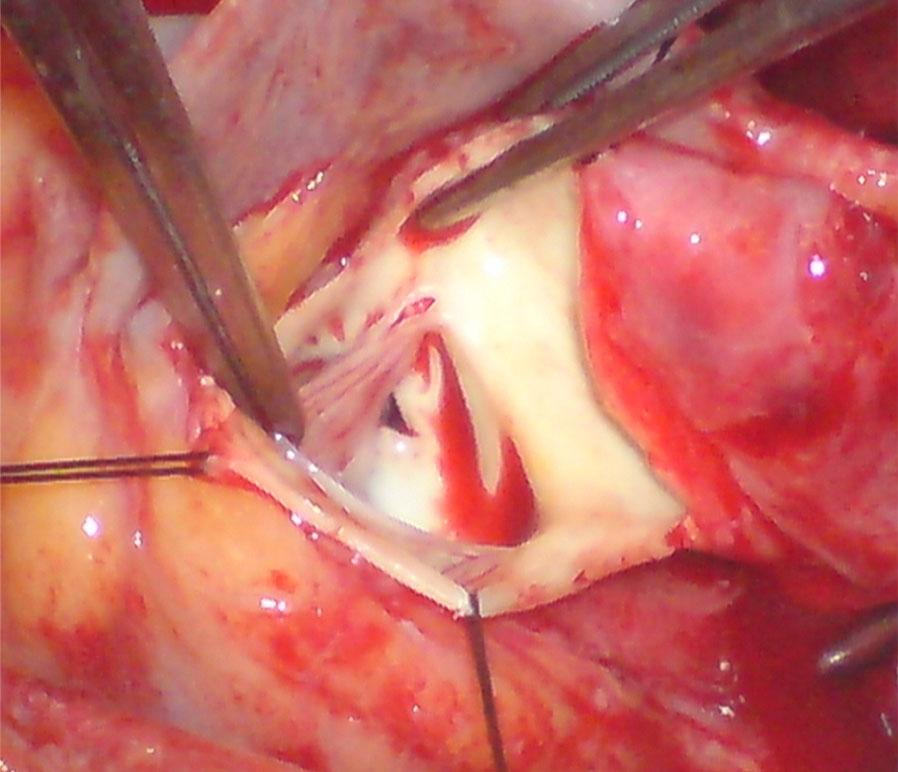 Of all reported aortato-left atrial fistula cases, penetrating traumas are the least common.