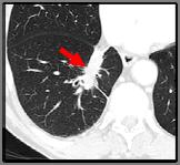 tumor at resection 78yo F, ex-smoker, adeno, PD-L1