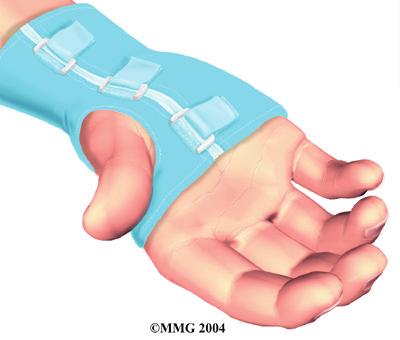 Some doctors feel this is a signal that a surgical release of the transverse carpal ligament would have a positive result.