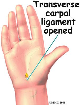 However, if the nerve pressure has been going on a long time, the median nerve may have thickened and scarred to the point that recovery after surgery is much slower.