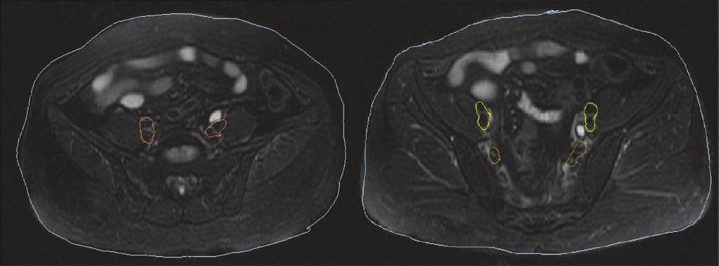 January 2014, Volume 1, Number 1 Figure 1. MRI images of iliac vessels acquired immediately before taking the simulation radiograph.