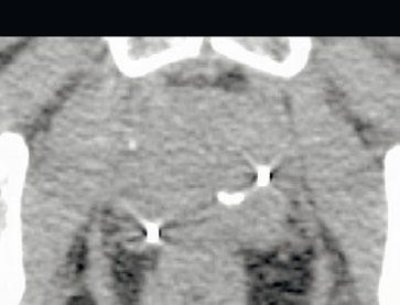 fixation and fiducial markers. The fiducial markers used in prostate are also quite visible using MRI.