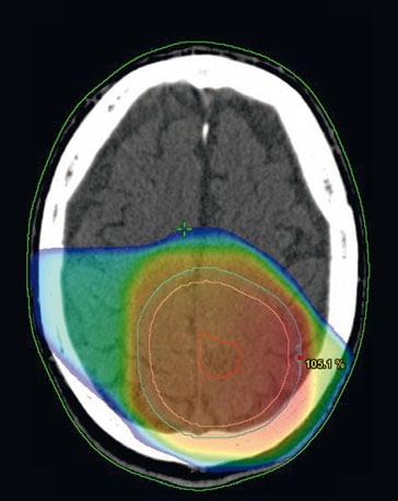User experiences Herlev University Hospital Advantages of using MRI in RT planning are the superb soft tissue visualization and true sagittal and coronal images, providing much better definition of