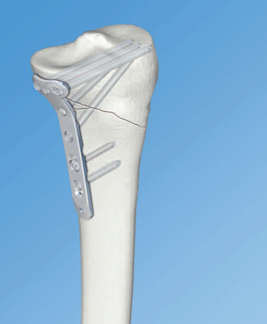 LCP Medial Proximal Tibial