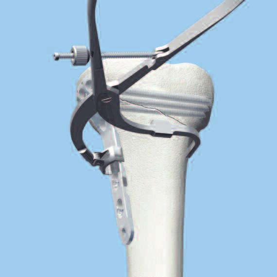 Using atraumatic technique, secure the plate to the tibial shaft with bone holding forceps. Confirm rotational alignment of the extremity by clinical examination.