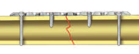 Correct Important: If a combination of cortex (1) and locking screws (2) is used, a cortex screw should be inserted first to pull the plate to the bone.