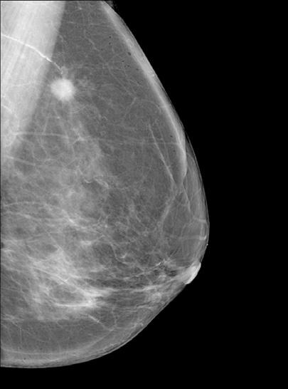 Power of Dual-Modality Imaging Aceso One out of every 8 women will be diagnosed with breast cancer during her lifetime, but if the cancer is detected early enough, it can be treated successfully.
