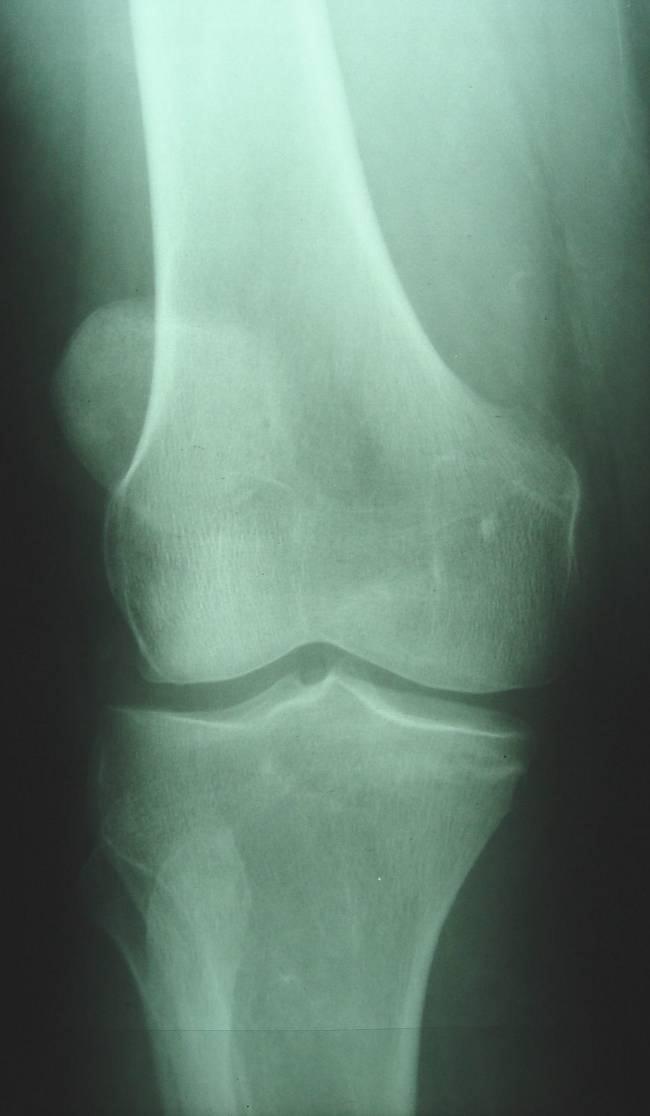 Tibial Plateau Fracture Fall with twist