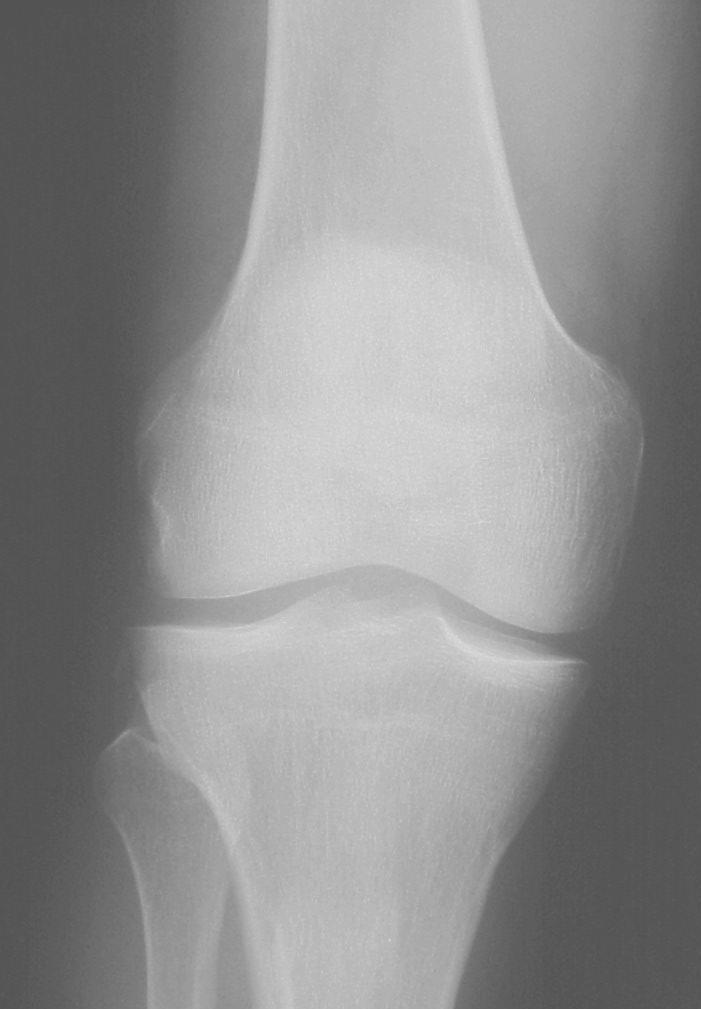 Segond Fracture Segond fracture suggests the presence of significant pathology A small,