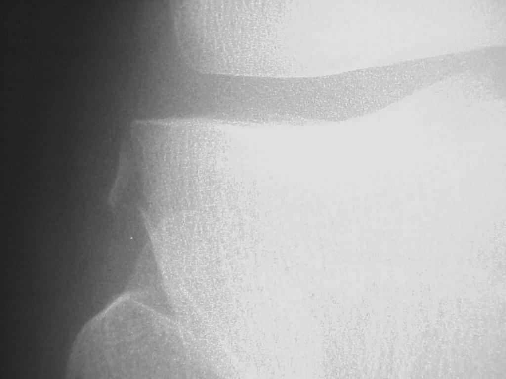 lateral tibia Nearly always associated with a tear of the anterior cruciate ligament in