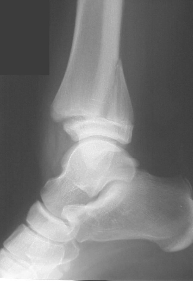SH2 fracture distal