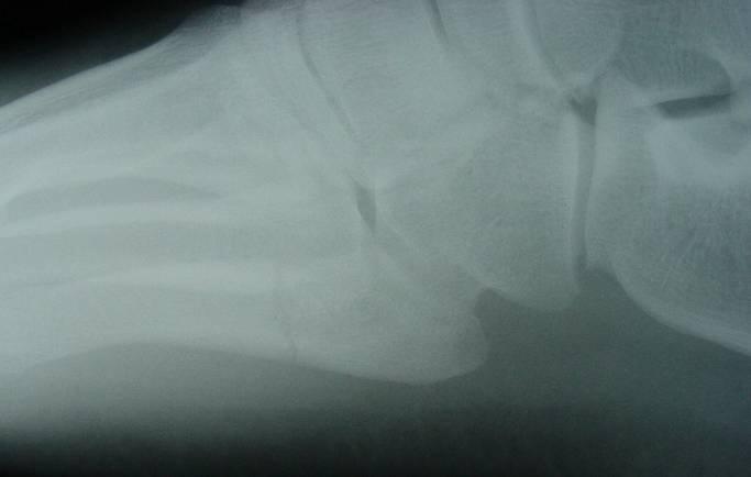 Ankle Injury - Check List Malleoli Lateral process of Talus Talar dome Anterior process of Calcaneus EDB