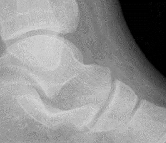 Ankle Injury - Check List Malleoli Lateral process of Talus Talar dome Anterior process of Calcaneus EDB