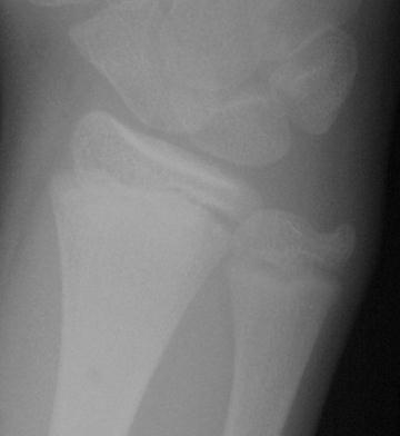 Childhood Fractures Tendons stronger than bone