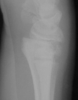 Salter Harris Incomplete fractures more common