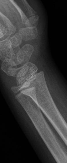 Childhood Fractures Tendons stronger than bone Apophyseal avulsion Fracture patterns different