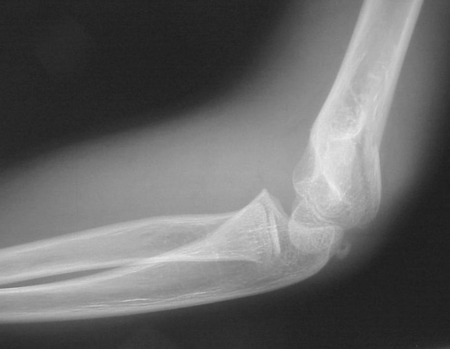 Alignment Rules Childhood Elbow Fractures Medial epicondyle fracture With dislocation in children Can become trapped in joint Radial head dislocation Radiocapitellar line