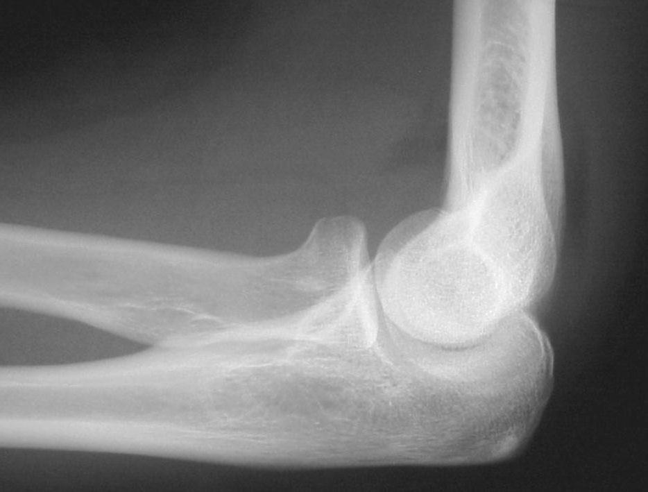 Secondary Signs Joint Effusion Secondary signs Joint effusion Lipohemarthrosis Gas in joint ST swelling Obliteration of