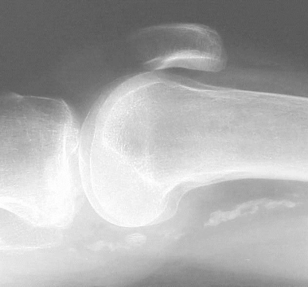 Secondary Signs Lipohemarthrosis Secondary signs Joint effusion Lipohemarthrosis Gas in joint ST swelling Obliteration of