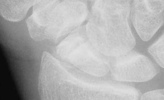 joint on CT Bone edema on CT Intraosseous Vacuum Delayed resorption Delayed