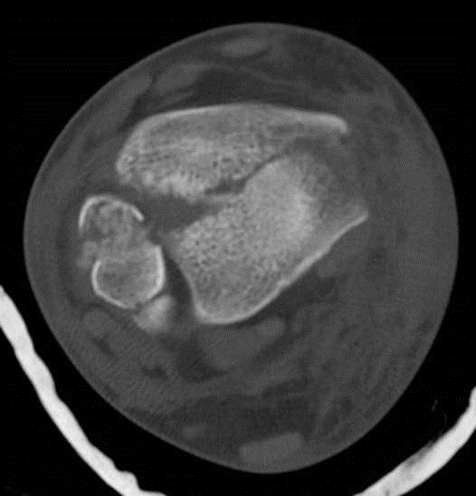 Secondary Signs Fat in joint on CT Secondary signs Joint effusion Lipohemarthrosis Gas in joint ST swelling Obliteration of