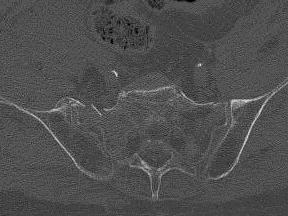Obliteration of fat planes Fat in joint on CT Bone edema