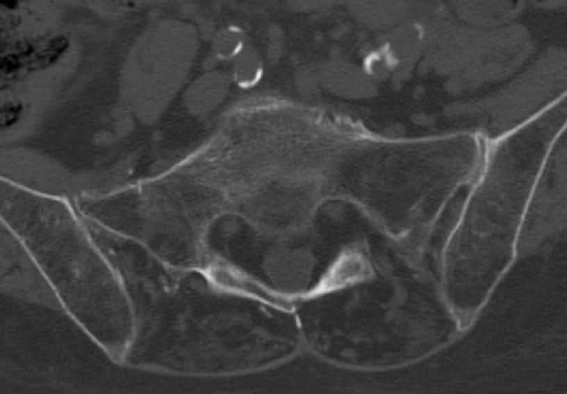 Obliteration of fat planes Fat in joint on CT Bone edema on