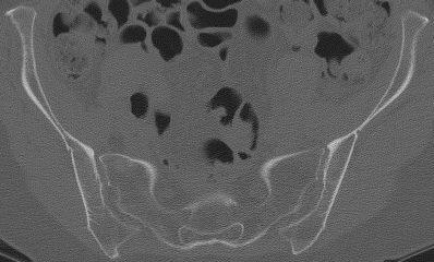 Secondary Signs Bone edema on CT Secondary signs Joint effusion Lipohemarthrosis Gas in joint ST swelling Obliteration of fat
