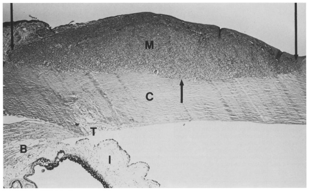 102 Fig. 1. Cross section of the limbal melanoma (M) extending between the three arrows to about half of the thickness of the peripheral cornea (C).