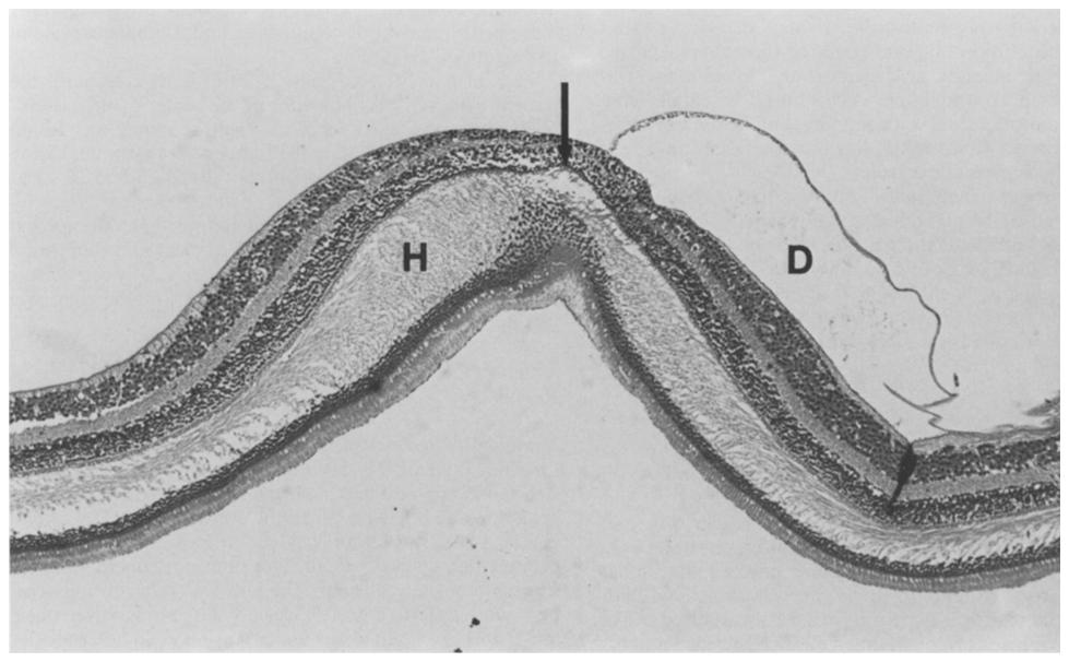 The foveola in horizontal cross section slightly below the center with combined detachment of inner limiting membrane and posterior vitreous face (D) containing a delicate