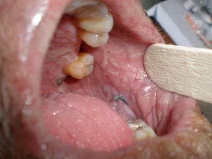 Fig 2: Mucosal infiltration over the hard palate and buccal mucosa. Tissue cultures from the site did not grow fungal or bacterial elements.
