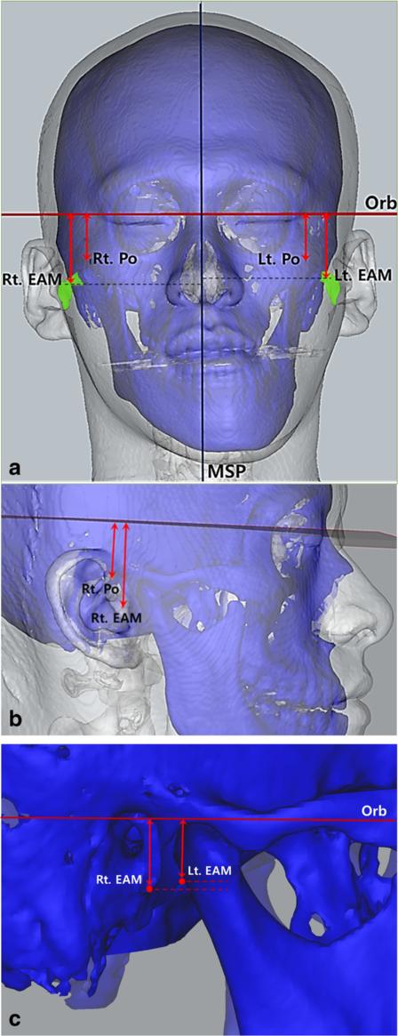 Choi et al. Maxillofacial Plastic and Reconstructive Surgery (2015) 37:33 Page 5 of 9 Fig. 2 Determination of EAM point on 3D CT image.