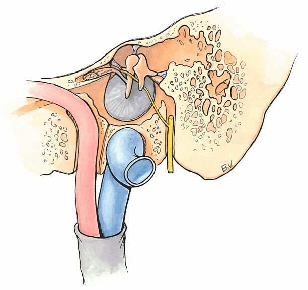 Tensor tympani Detailed Diagram of Lateral Wall of Middle Ear Cavity (Inside the cavity looking out) Attic Tegmen tympani