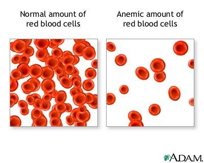 Lead Poisoning and Anemia Lead intoxication can cause anemia Anemia decreases quantity