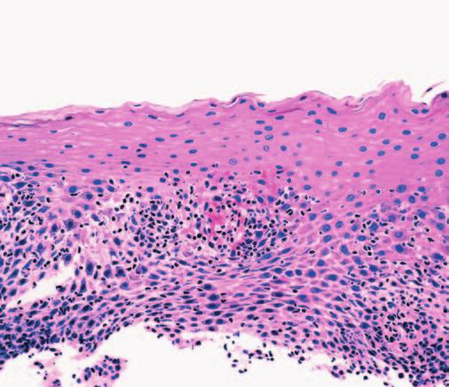 In these dermatitides, the epidermis is of normal thickness and spongiotic, with exocytosis of lymphocytes, and sometimes other inflammatory cells, into spongiotic foci.