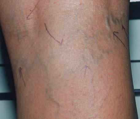Reticular Veins Enlarged, greenish-blue appearing veins Frequently associated with