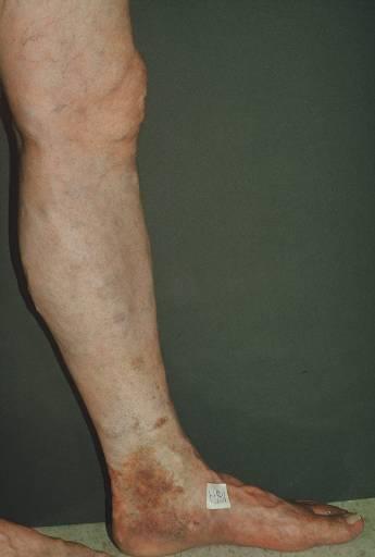Great Saphenous Insufficiency Skin changes are seen along the medial aspect of the ankle The presence of skin changes is a