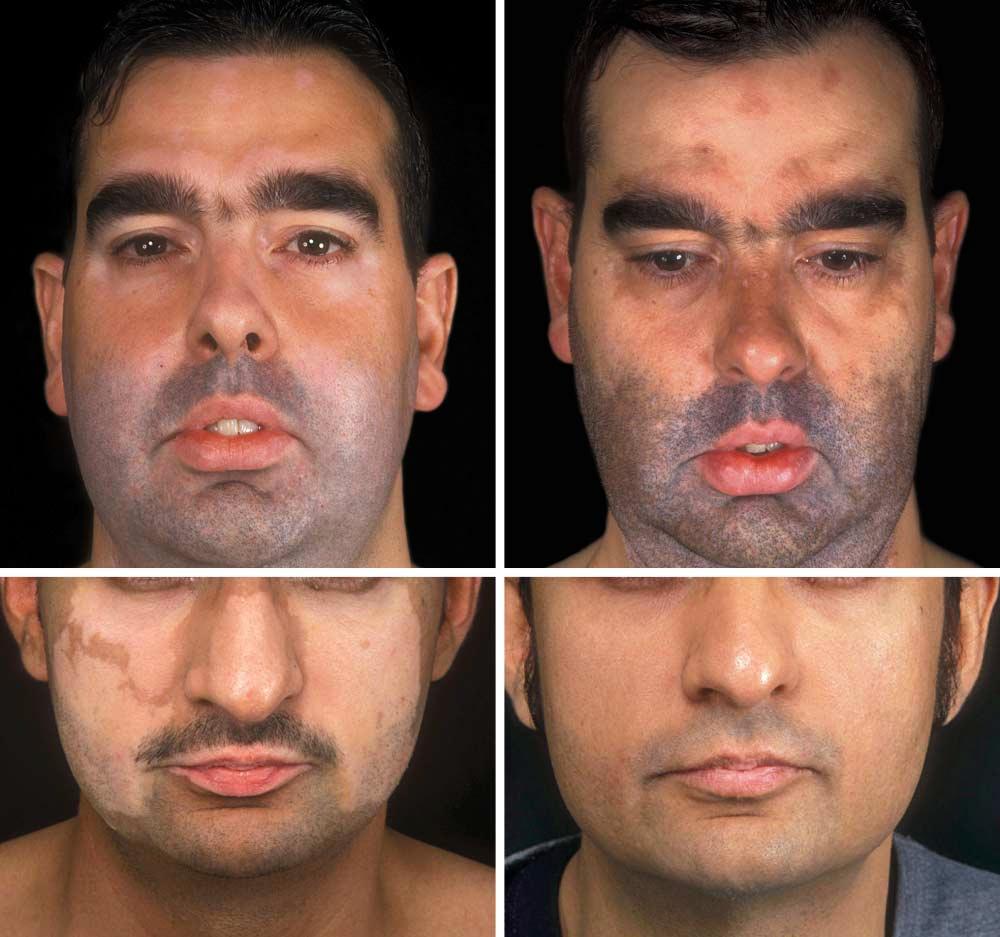 A B C D Figure 3. Improvement in vitiligo in patients treated with oral psoralen followed by irradiation with UV-A (PUVA) and narrowband UV-B (NB-UVB). A, A patient before therapy.