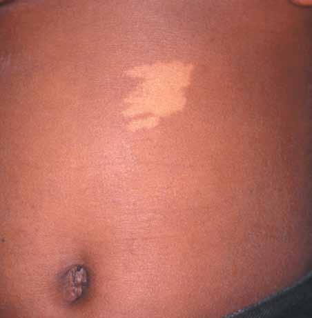 ) Case 5: A 32-year-old man presents with a hypopigmented lesion on his left flank. The lesion has been present since infancy.