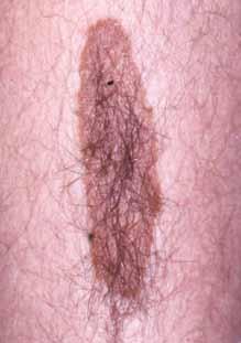 Photo Quiz Answers Do You Know Your Nevi (Continued) The patient has a congenital hairy nevus. Congenital nevi are present at birth and can vary in size from a few millimeters to many centimeters.